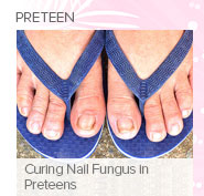 Curing Nail Fungus in Preteens